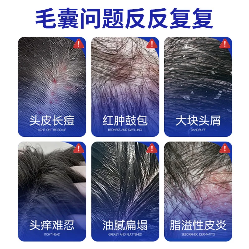 葵花溢脂性皮炎非洗发水240ml