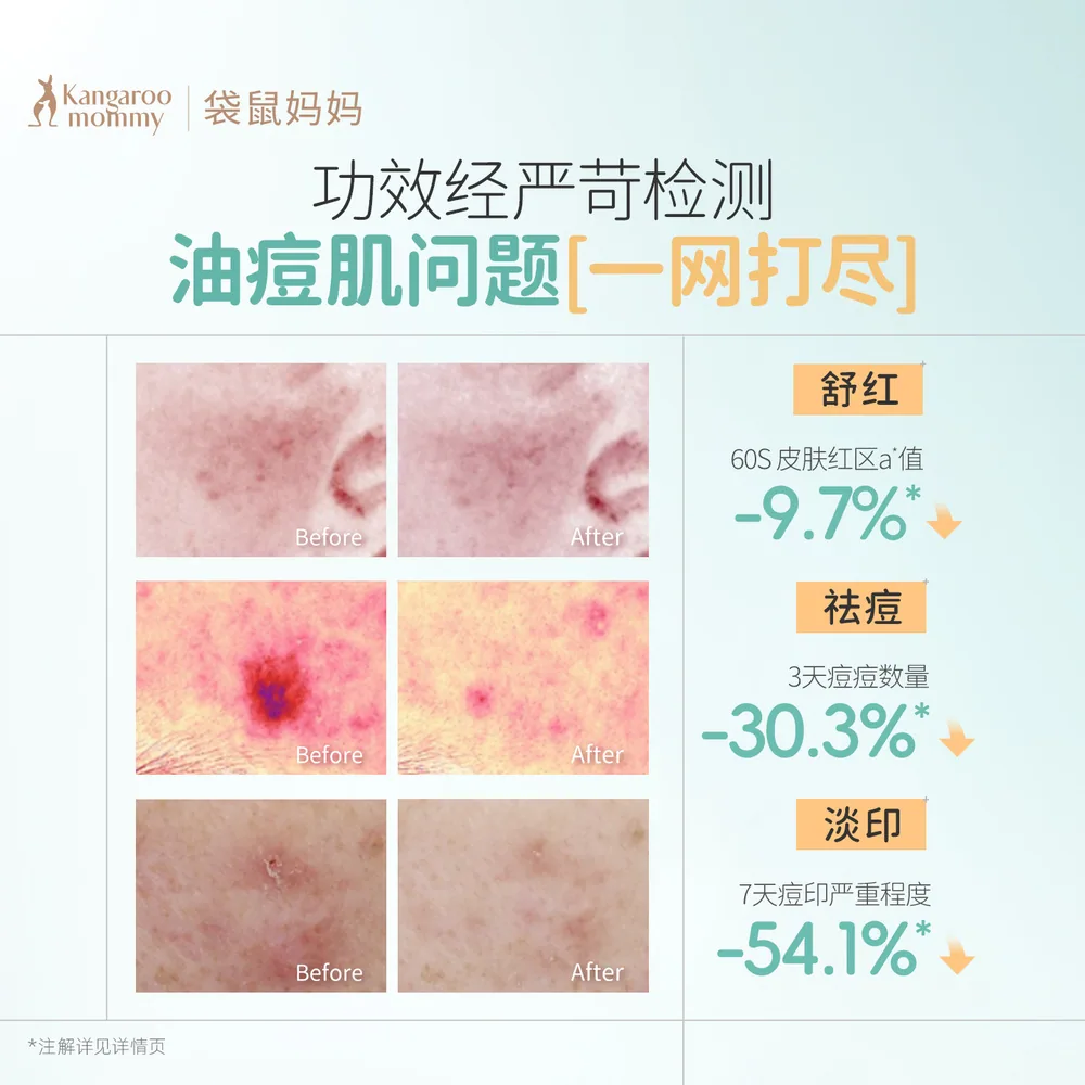 袋鼠妈妈祛痘棉片去黑头湿敷清洁（细节图 1）