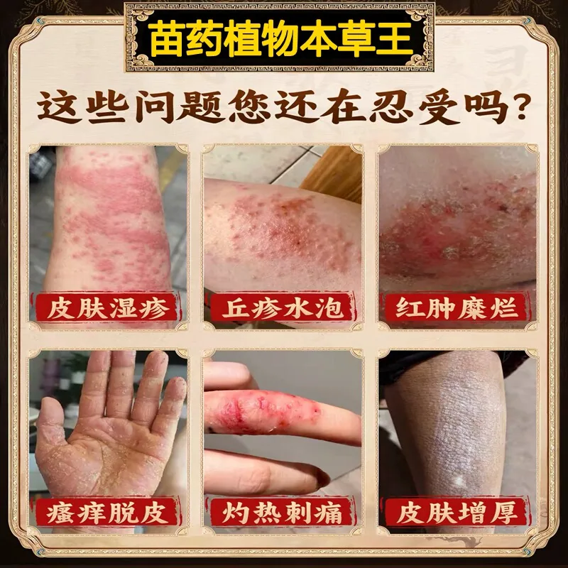 滋舒承千年苗族传承拔毒止痒膏抑菌膏（细节图 2）