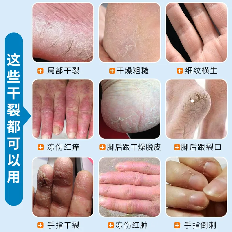 凡士林干裂贴手足100贴